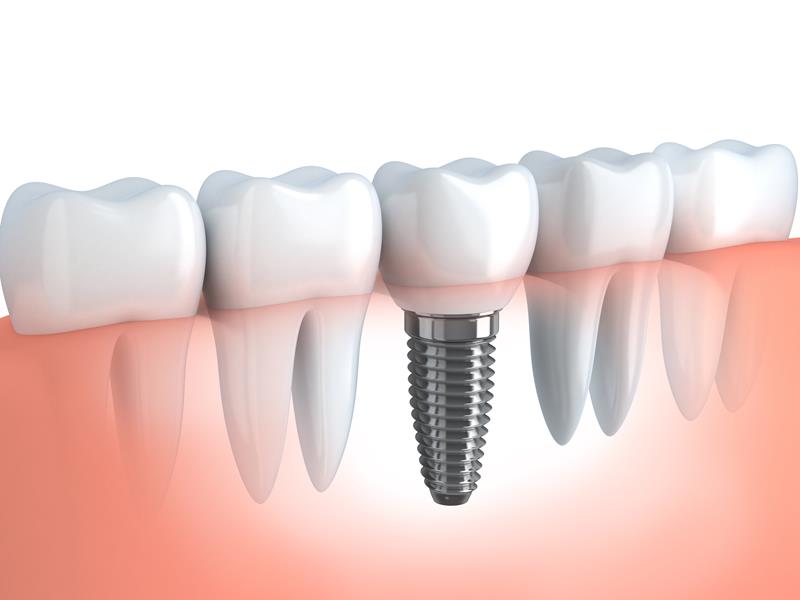 Dental Implants Mineola, NY 